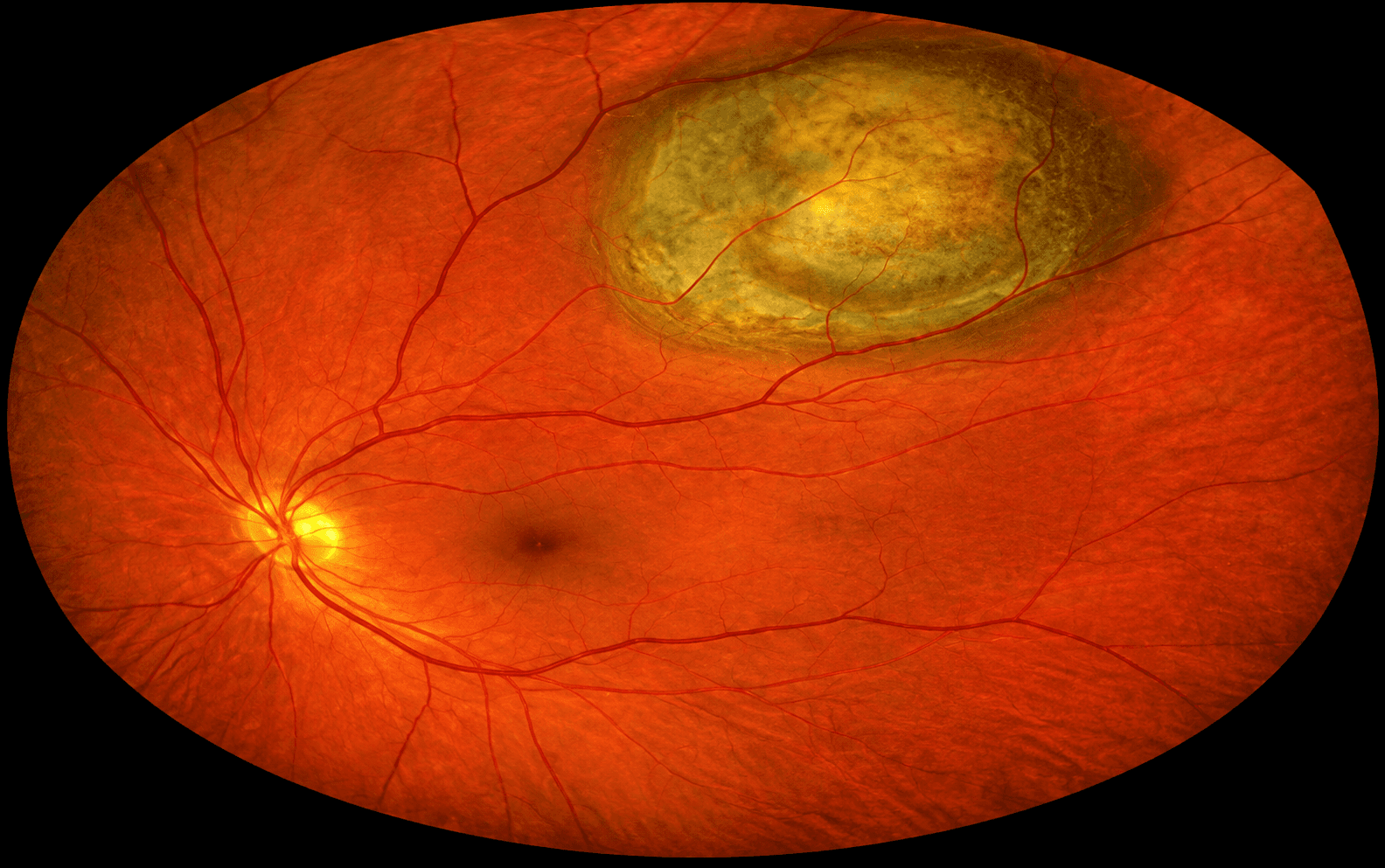 Wide-field retinal photograph showing a choroidal melanoma.