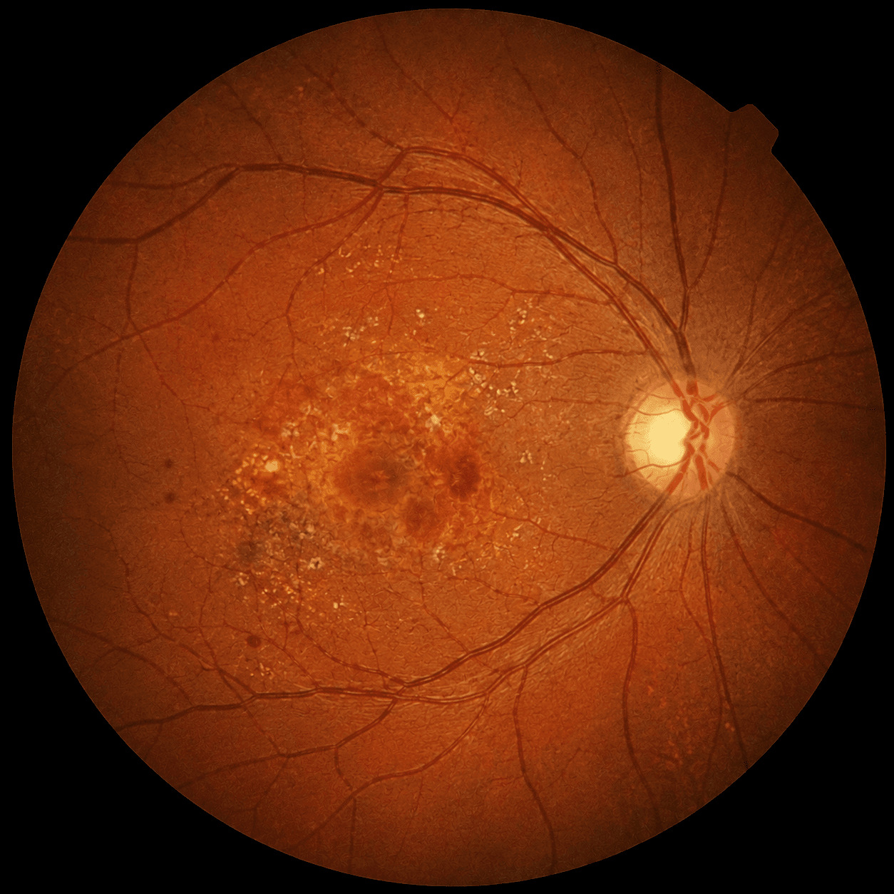 Macular degeneration
