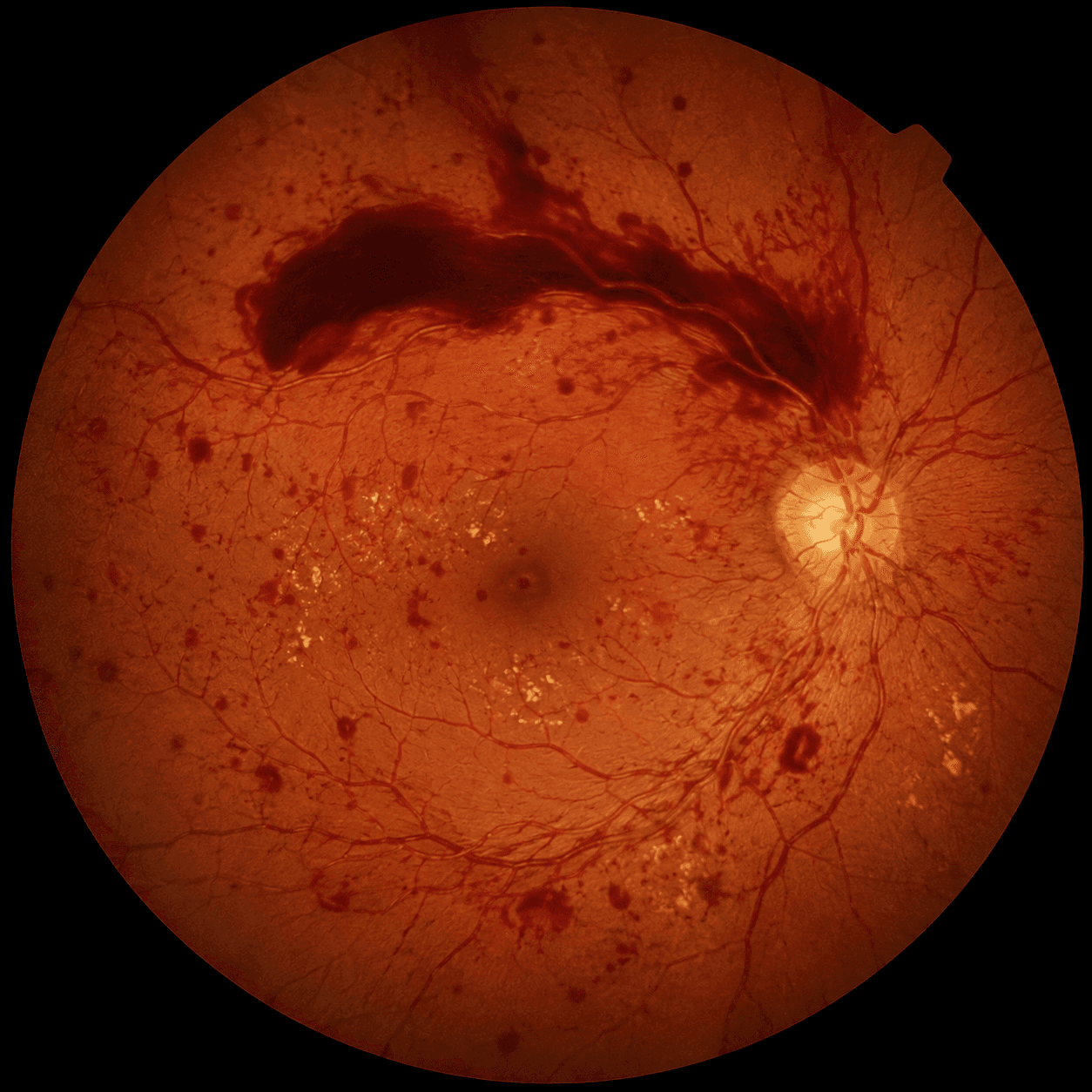 Diabetic retinopathy