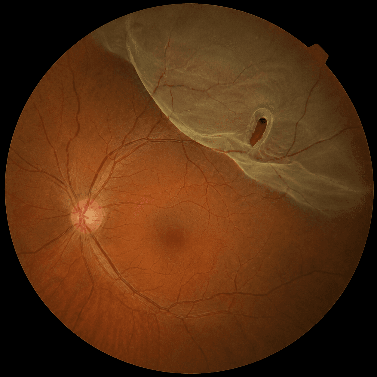 Retinal detachment