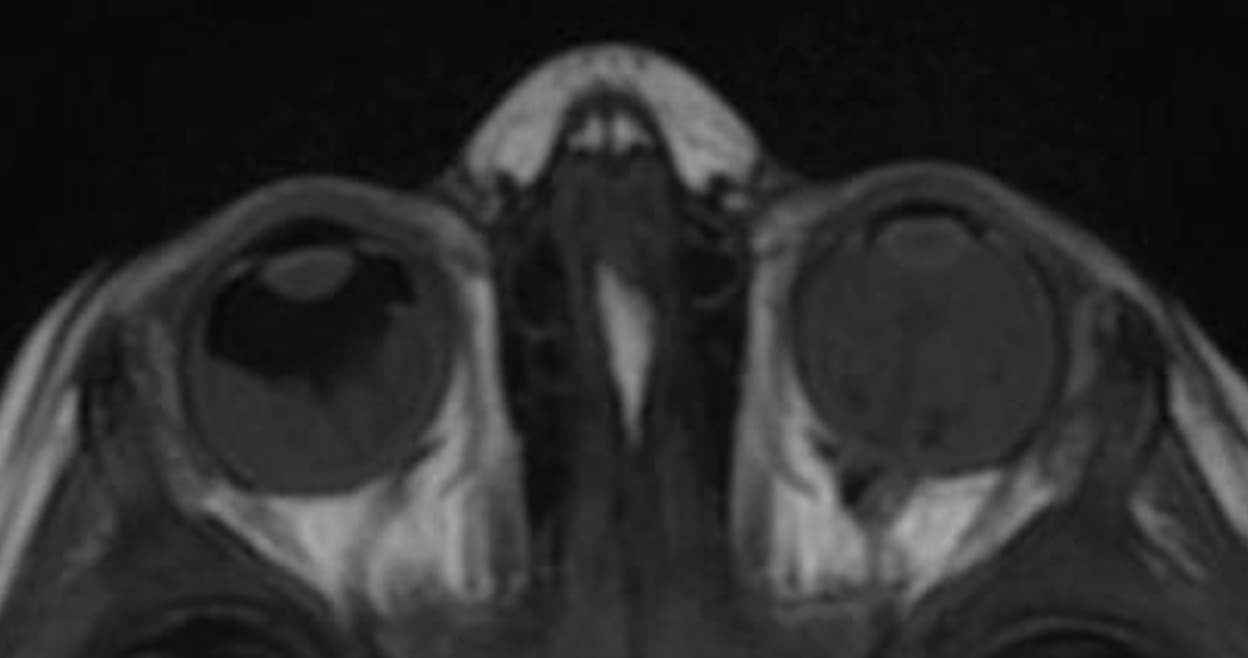 MRI Scan