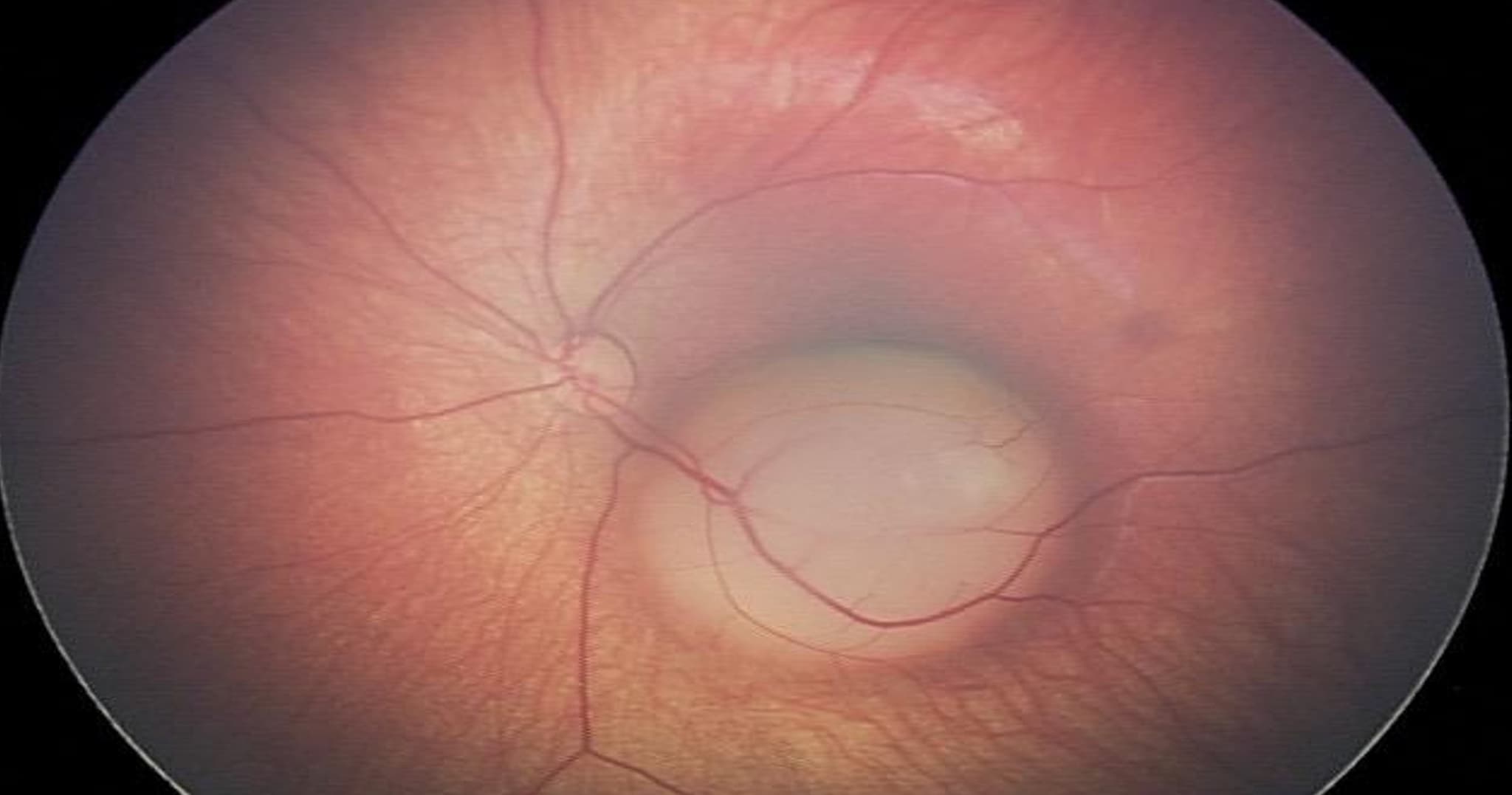 Fundus photograph showing retinoblastoma
