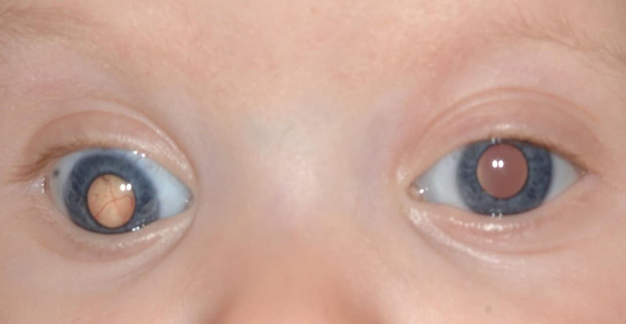 Crossed Eyes (Strabismus)