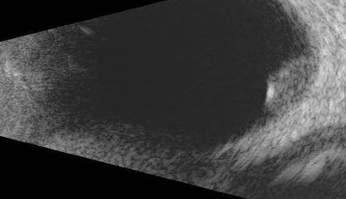 Ultrasound