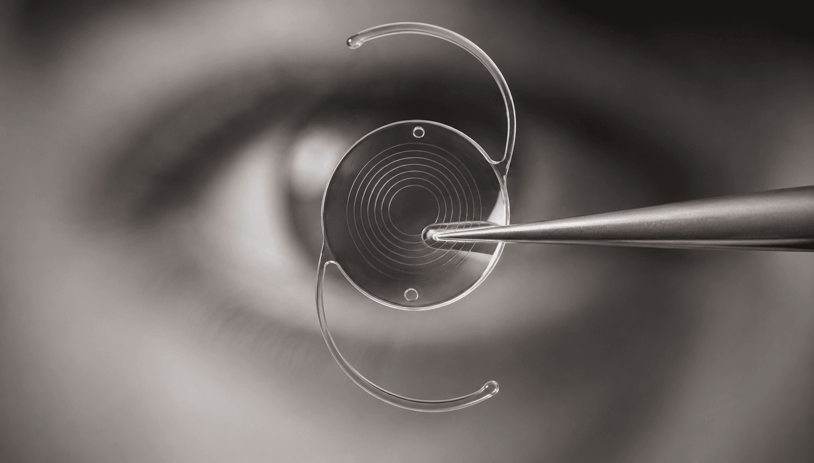 Illustration of modern cataract surgery using phacoemulsification